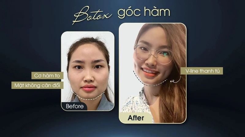 công dụng tiêm botox gọn hàm