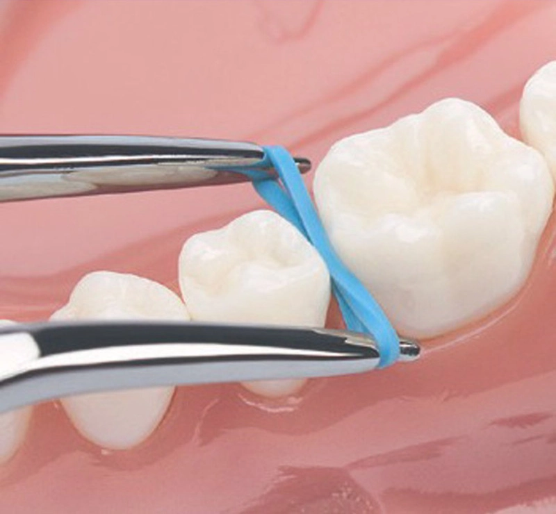 đặt chun tách kẽ răng