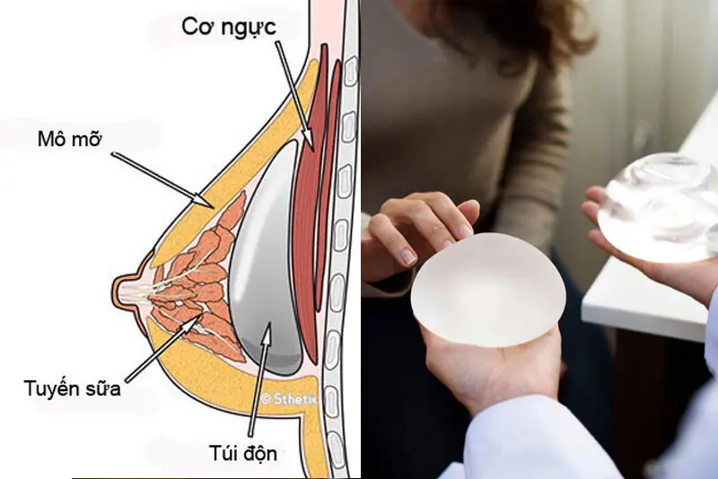 Ưu điểm khi nâng ngực bằng túi độn
