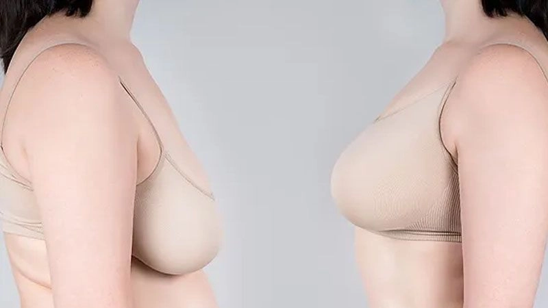 Những ai đủ điều kiện có thể phẫu thuật đặt túi ngực