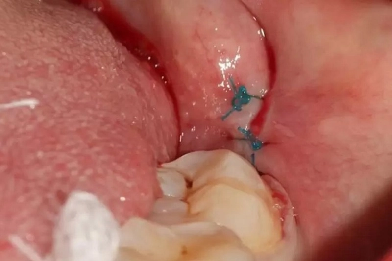 dấu hiệu nhiễm trùng sau khi nhổ răng khôn