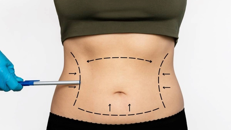 điều kiện hút mỡ bụng