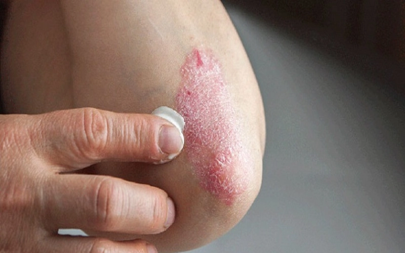 Điều trị chàm bằng thuốc và chăm sóc da