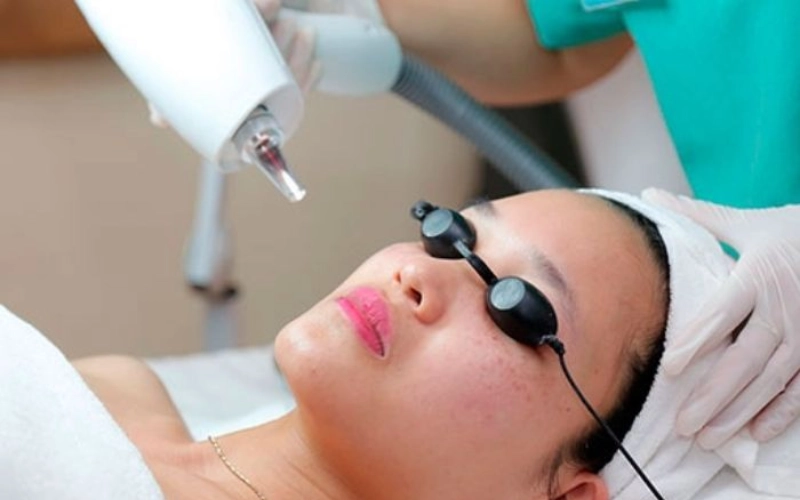 Điều trị bớt bằng công nghệ laser