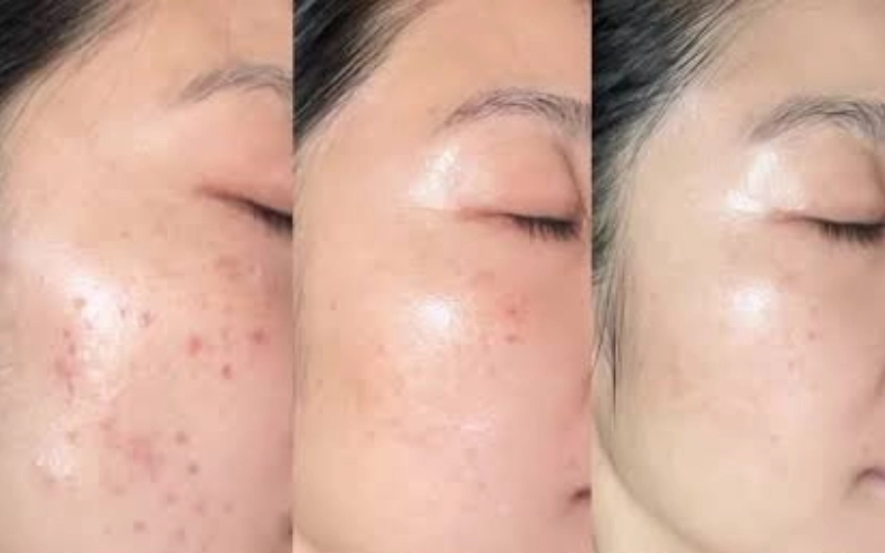 Điều trị chàm, bớt có hết hoàn toàn không?