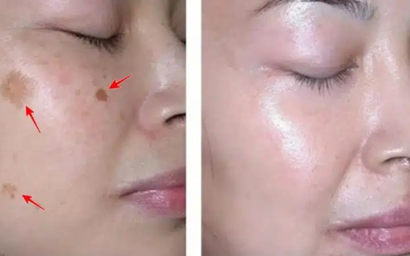 Điều trị chàm có tái phát không?