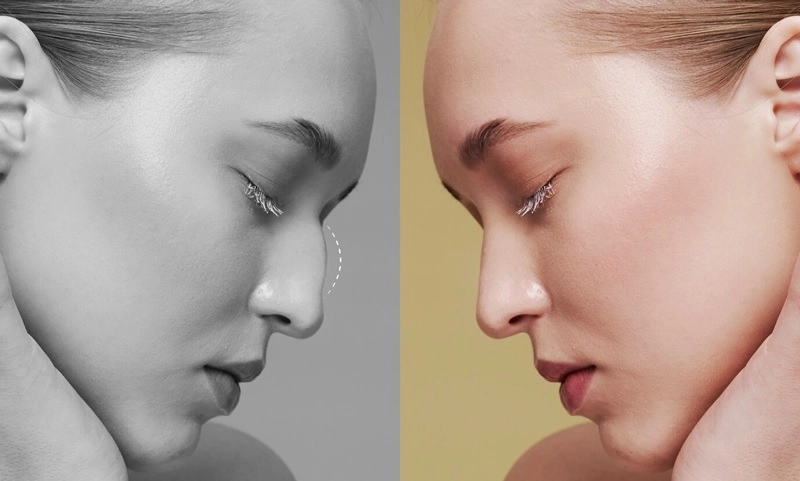 độ khó và tình trạng mũi ban đầu