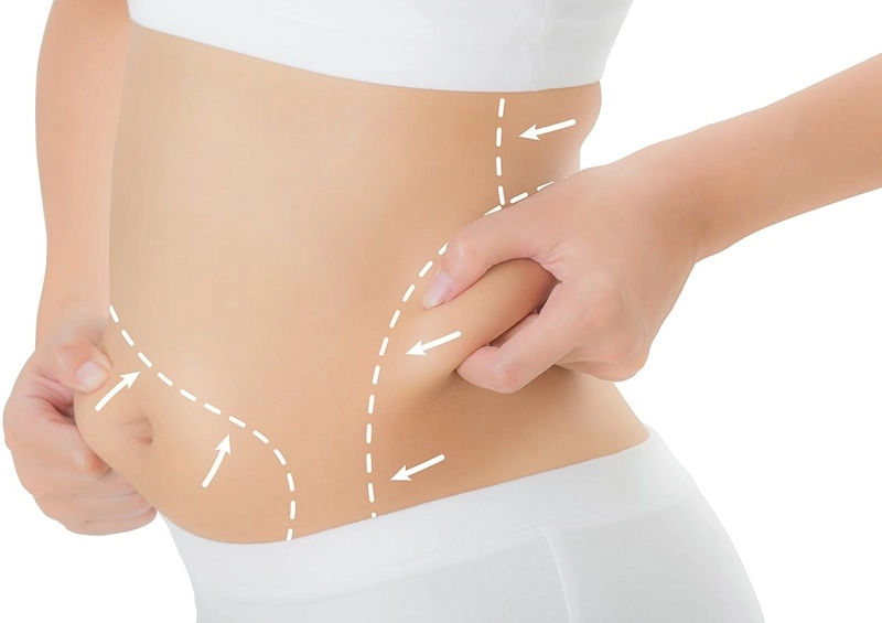 đối tượng phù hợp hút mỡ vaser lipo