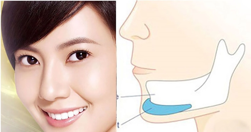 Độn cằm bằng sụn nhân tạo