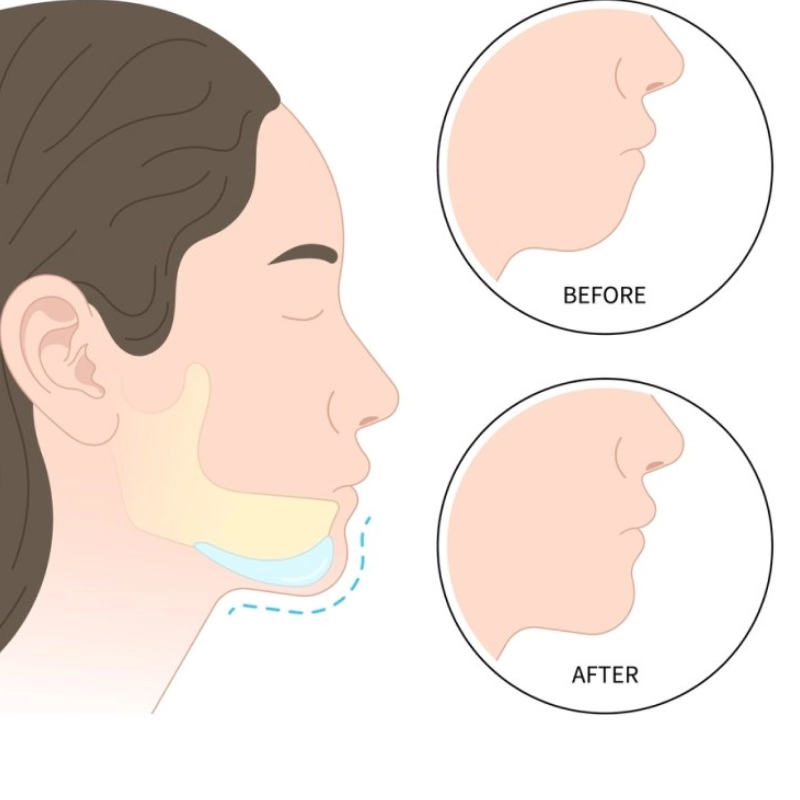 Ưu điểm của độn cằm