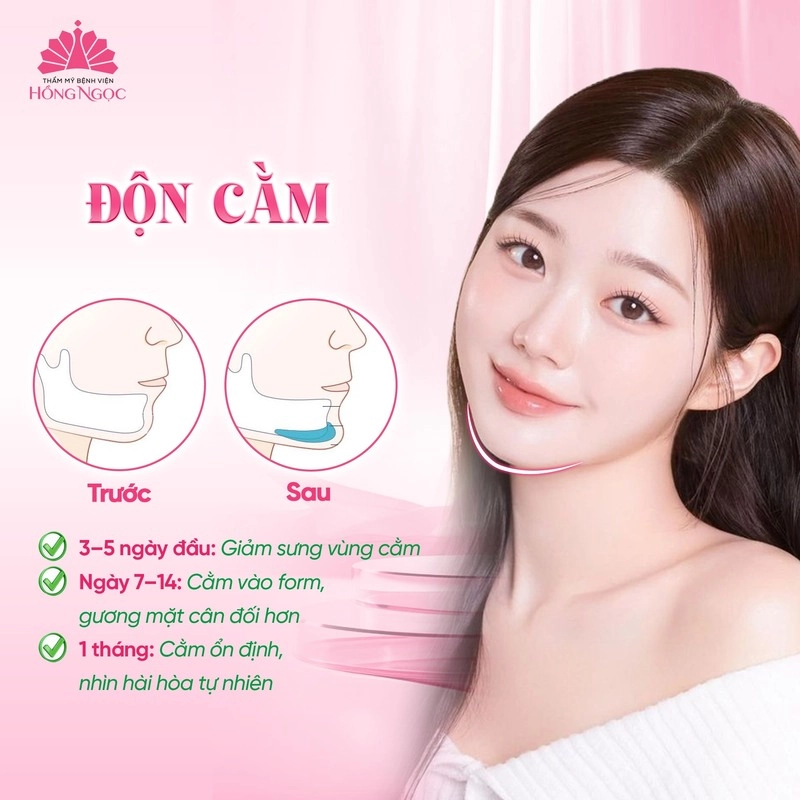 độn cằm tại hồng ngọc 