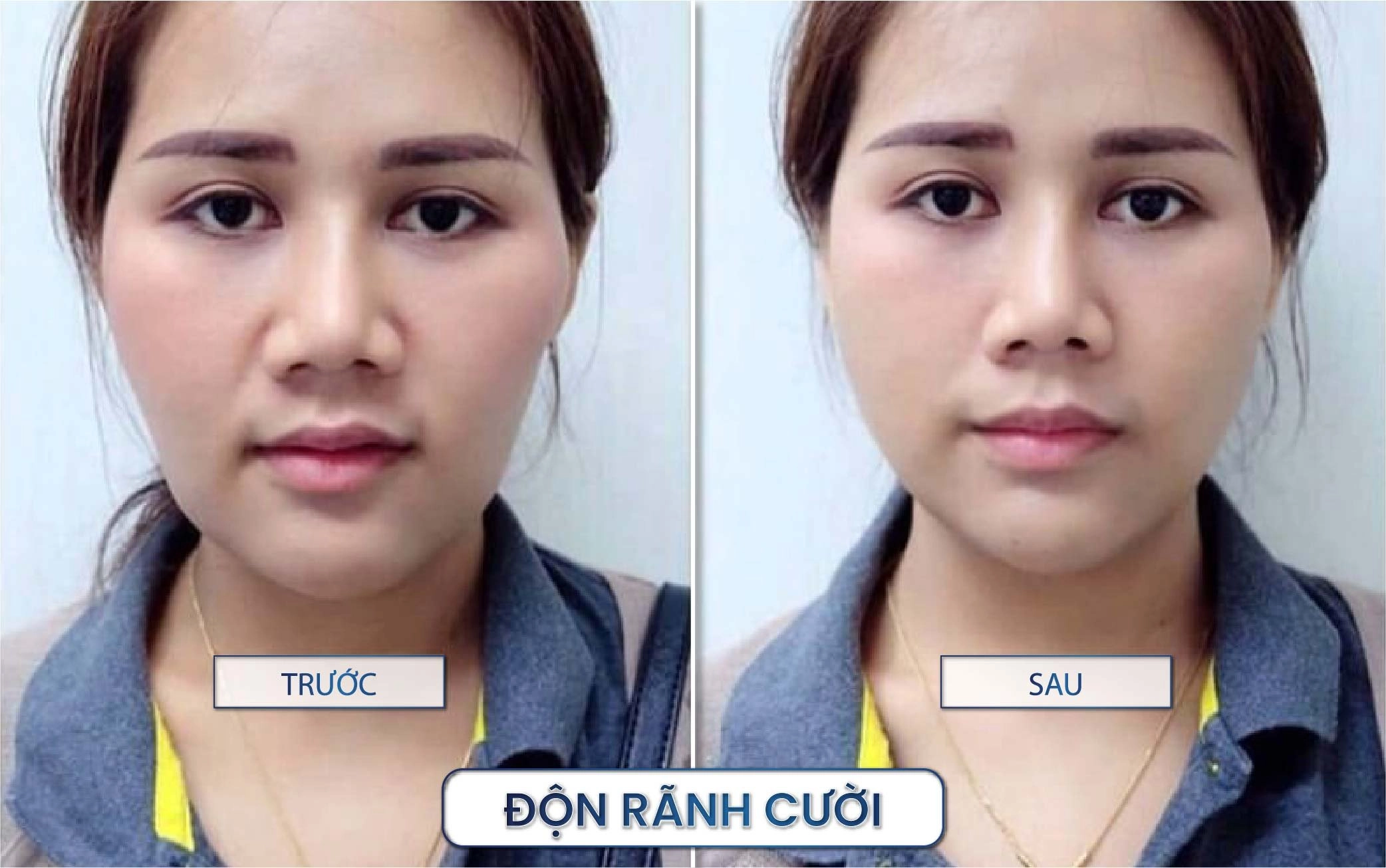 Độn rãnh cười là phương pháp thẩm mỹ nhằm làm đầy vùng rãnh mũi – má