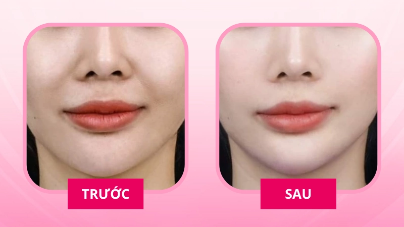 độn rãnh cười