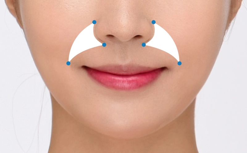Độn rãnh cười là giải pháp trẻ hóa phù hợp với nhiều đối tượng khác nhau