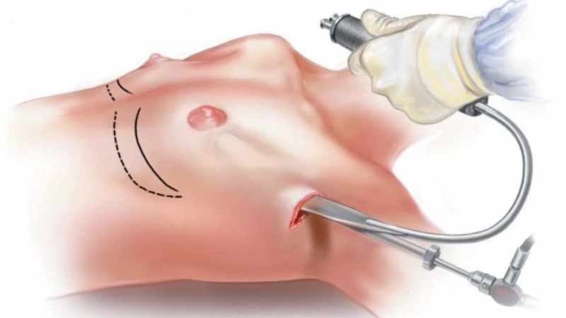 nâng ngực nên chọn đường mổ nào