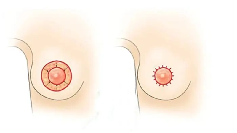 nâng ngực nên chọn đường mổ nào