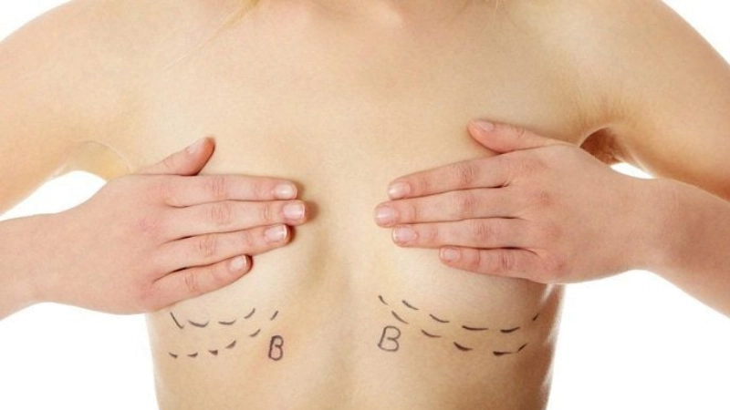 nâng ngực nên chọn đường mổ nào