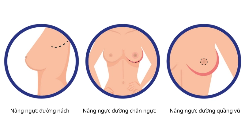 nâng ngực nên chọn đường mổ nào