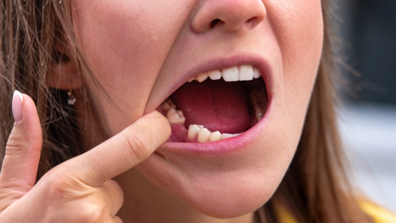 giải đáp 101 câu hỏi thường gặp về niềng răng
