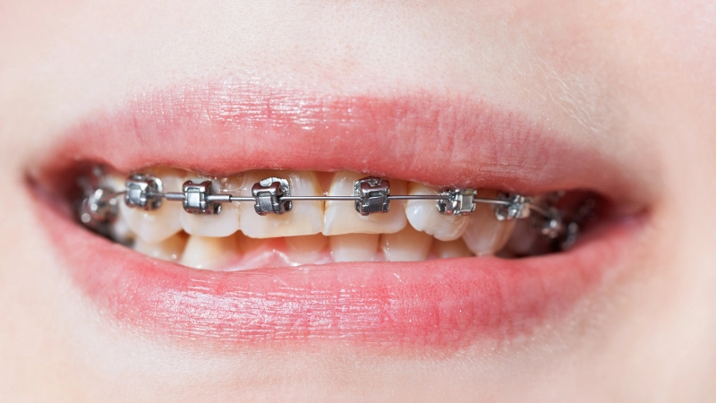 giải đáp 101 câu hỏi thường gặp về niềng răng
