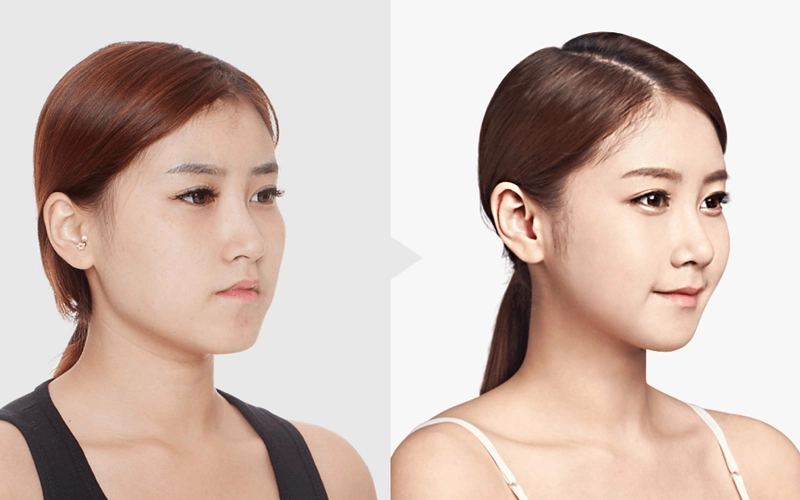 Những ai nên thực hiện hút mỡ mặt?