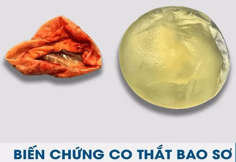 hạn chế biến chứng bao xơ