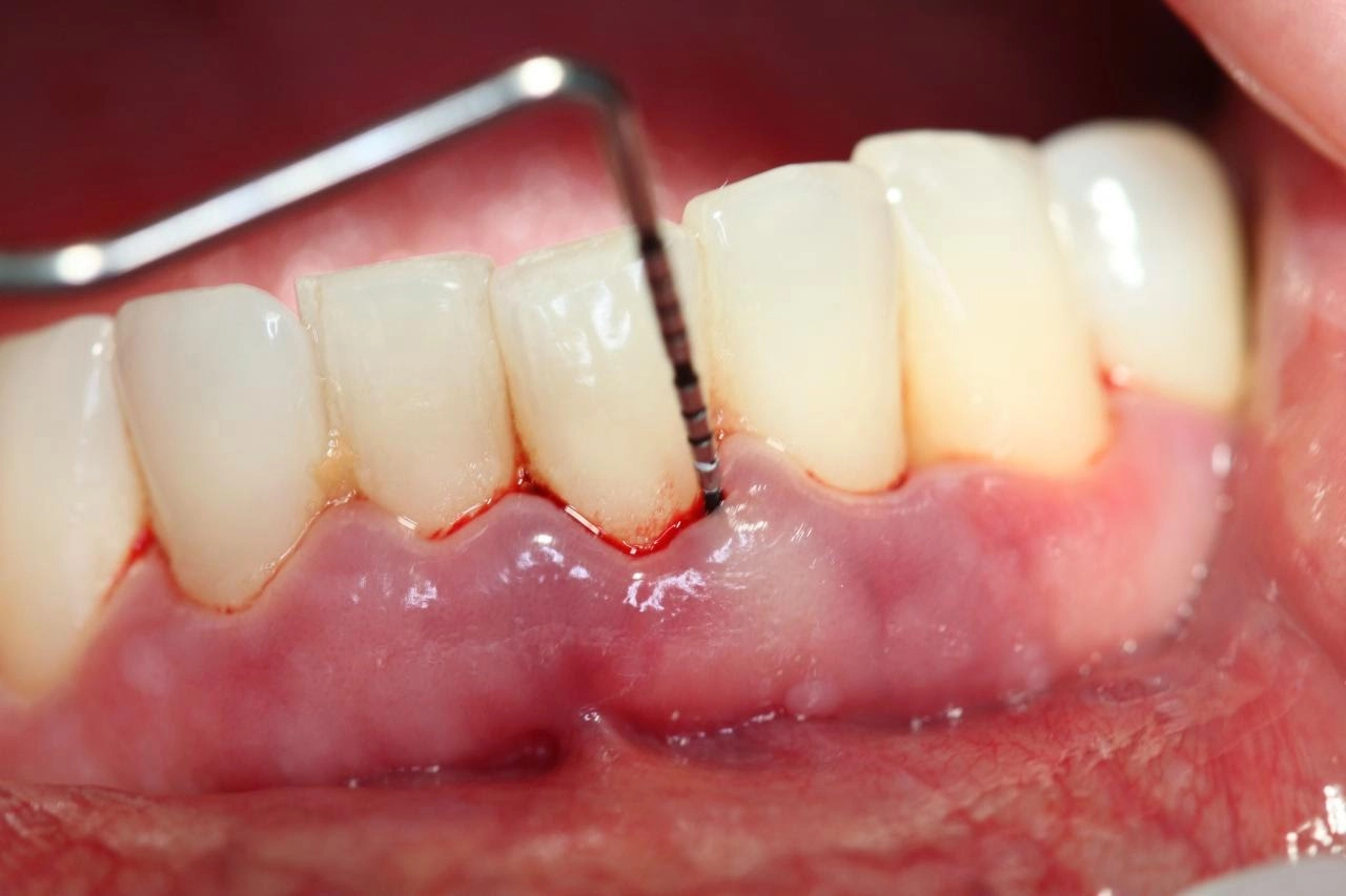 Viêm nha chu (Periodontitis)