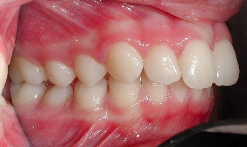 hô do xương hàm