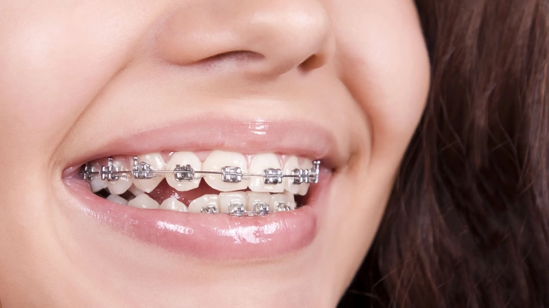 hướng dẫn cách chăm sóc răng miệng khi niềng răng