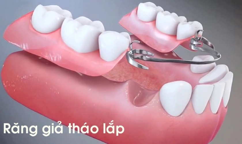 Quy trình thực hiện răng giả tháo lắp diễn ra như thế nào?