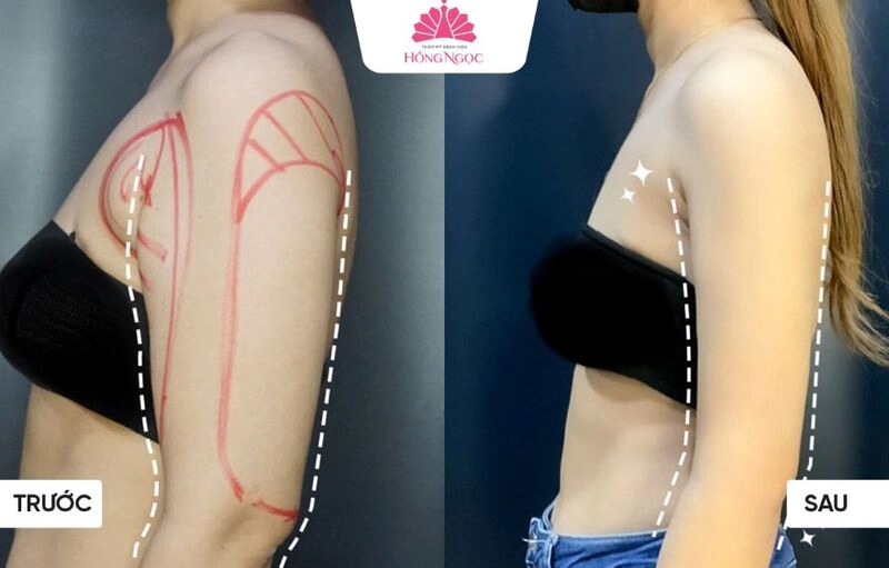 Trường hợp nào nên & không nên thực hiện hút mỡ bắp tay?