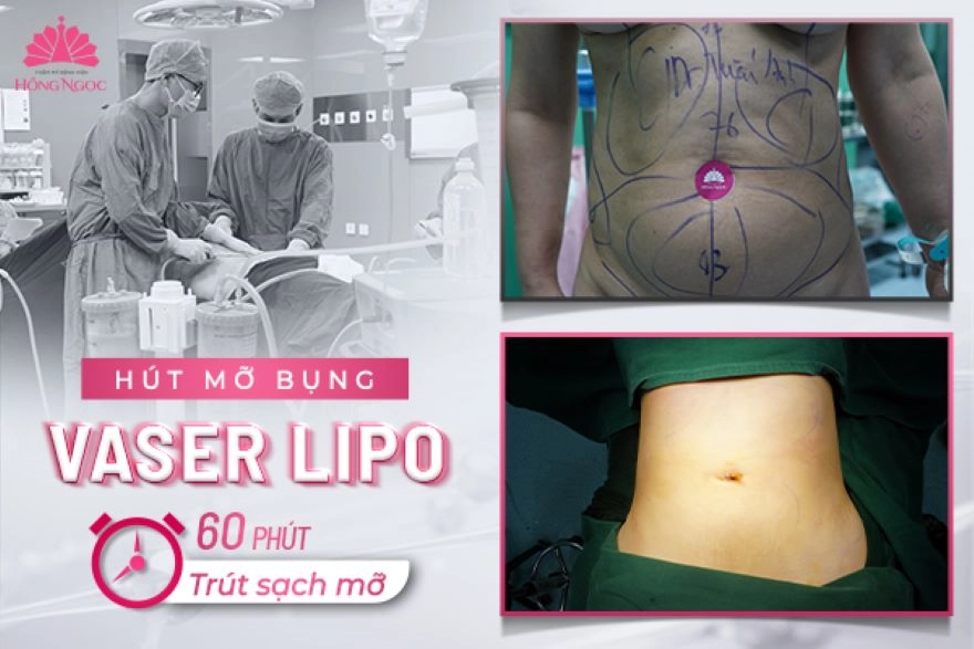 Hút mỡ bụng Vaser Lipo
