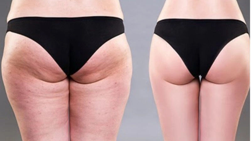 hút mỡ đùi
