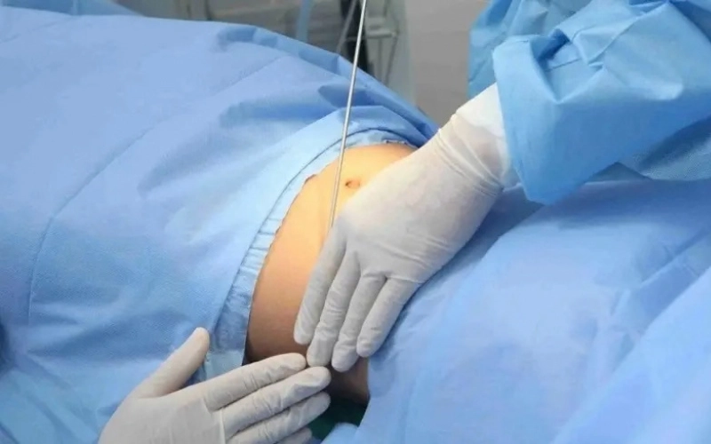 Hút mỡ là gì? Vì sao ngày càng được ưa chuộng?
