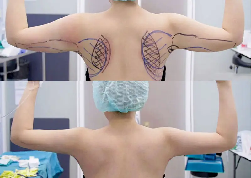 Ưu điểm của dịch vụ hút mỡ lưng