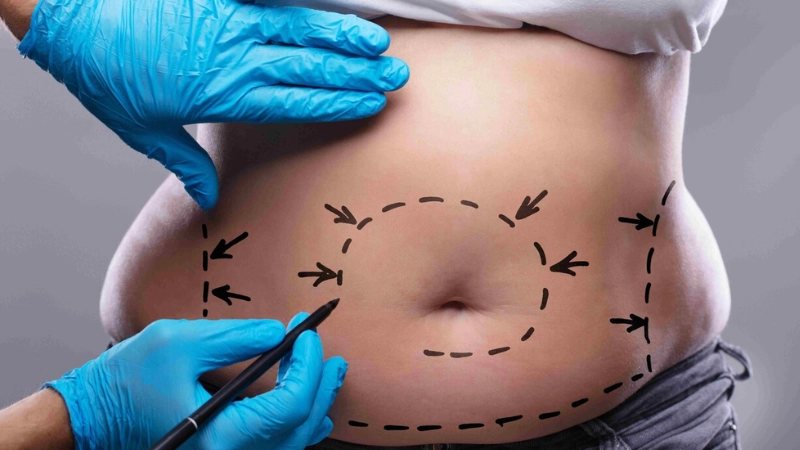 hút mỡ bụng siết cơ vaser lipo