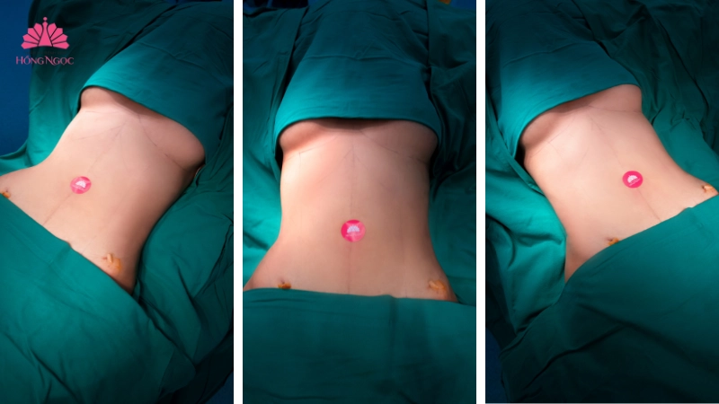 hút mỡ bụng siết cơ Vaser Lipo