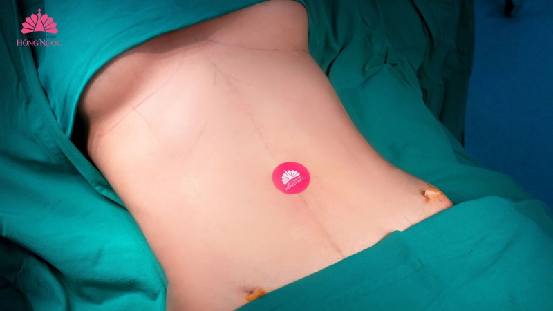 hút mỡ bụng siết cơ vaser lipo