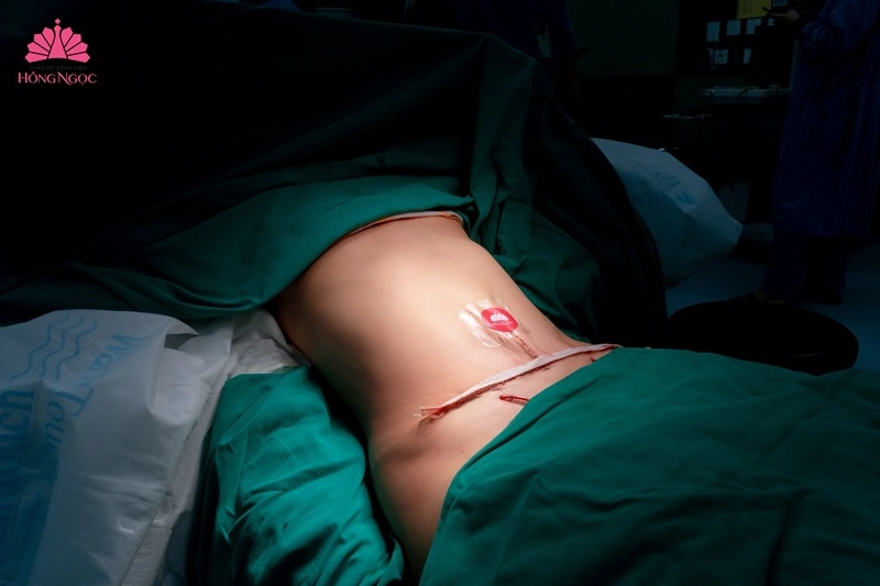 hút mỡ tạo hình thành bụng