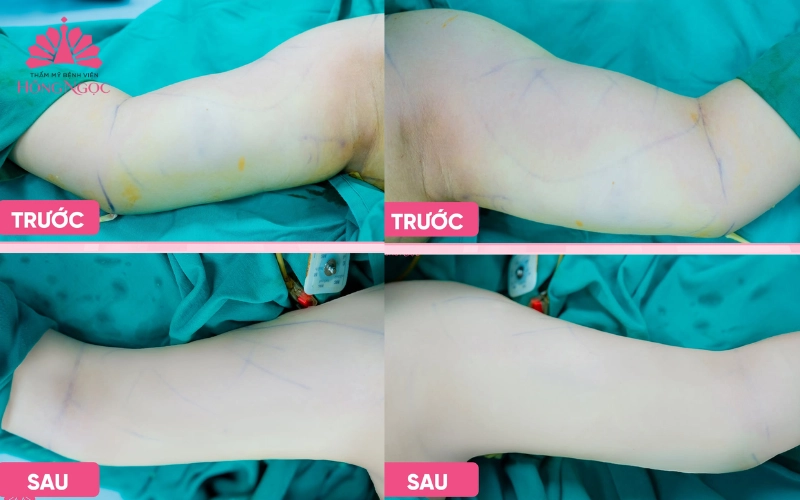 Hút mỡ Vaser Lipo là gì?