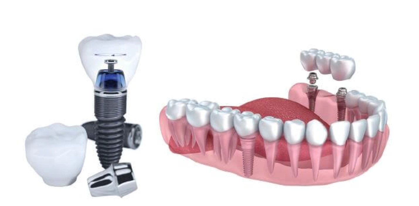 Trồng răng Implant là gì?