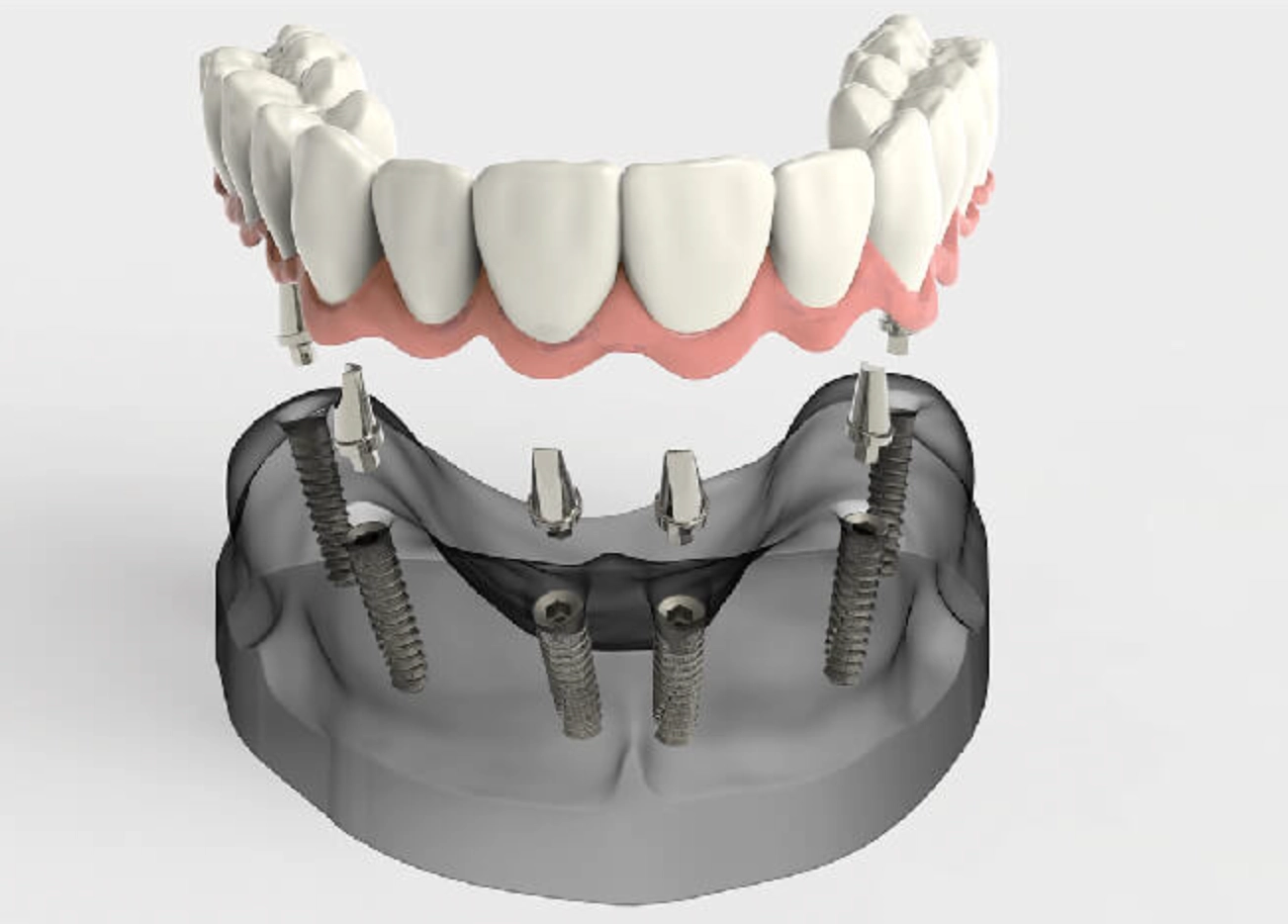Mô hình minh hoạ trồng Implant toàn hàm