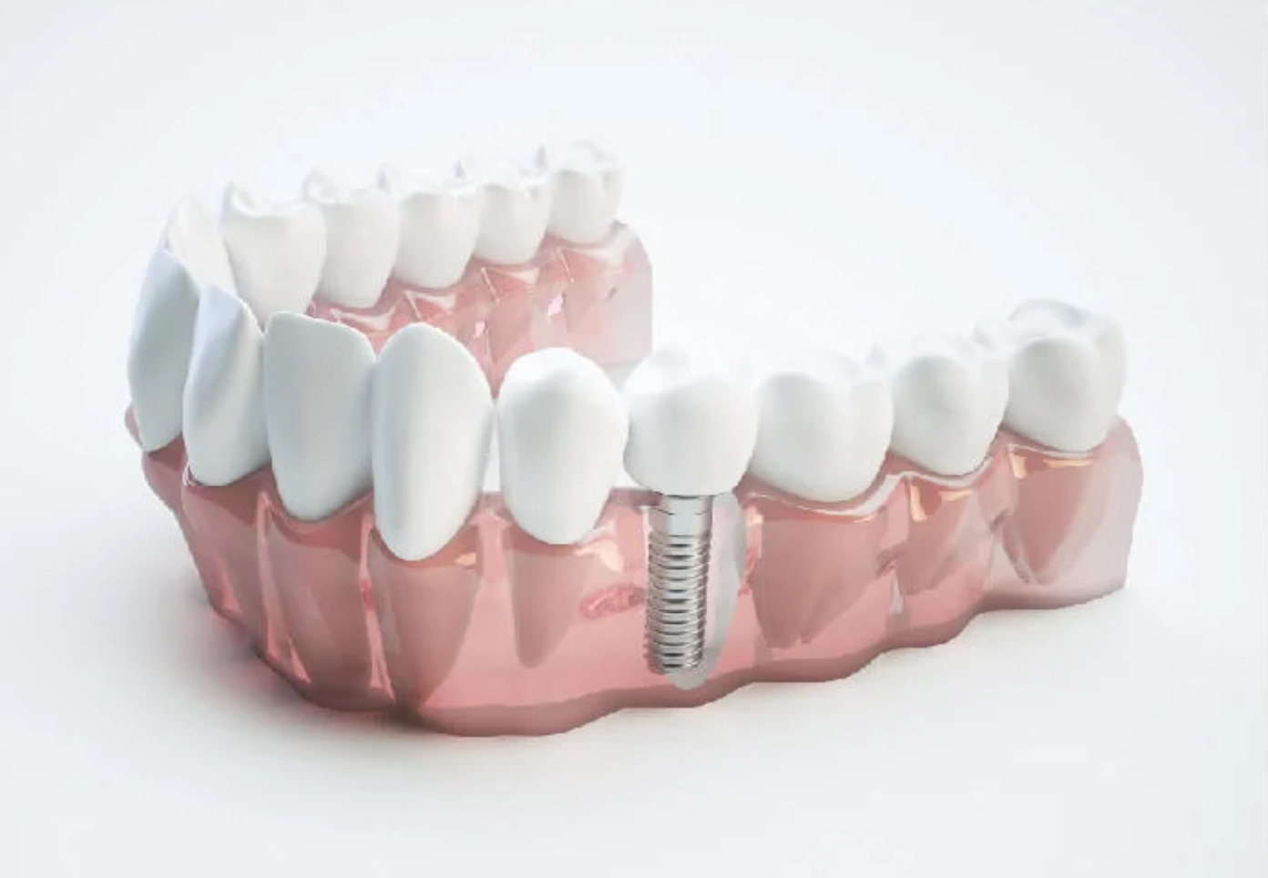 Mô hình minh hoạ trồng Implant đơn lẻ