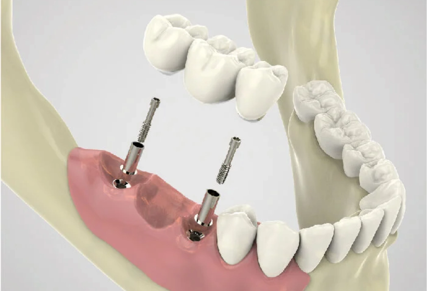 Mô hình minh hoạ cầu răng sứ trên Implant