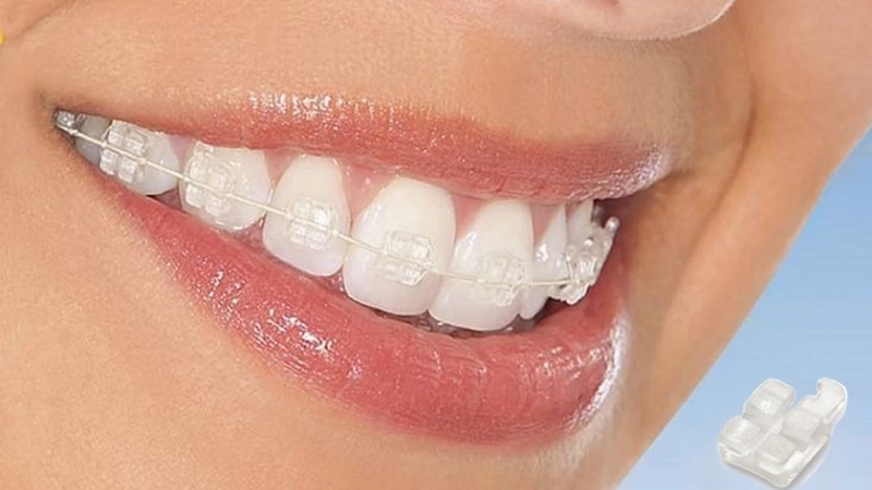 Niềng răng mắc cài sứ đồng nhất với màu răng, thẩm mỹ cao