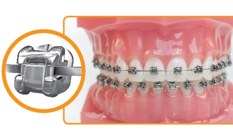 Minh họa niềng răng mắc cài kim loại thép không gỉ