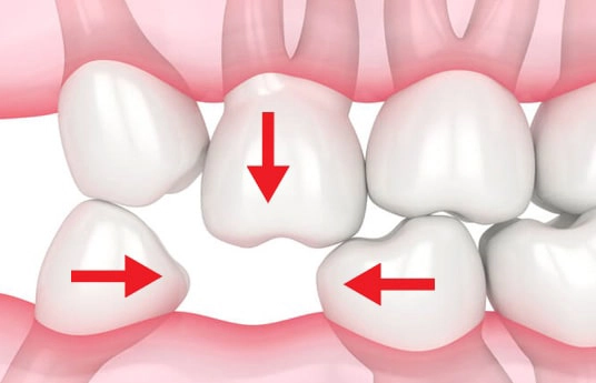 Tại sao cần thực hiện trồng răng sớm?