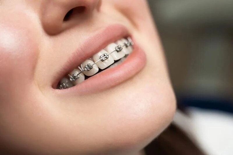 Niềng răng mắc cài kim loại