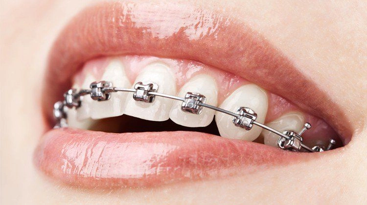 Trường hợp không cần đến nhổ răng khi niềng