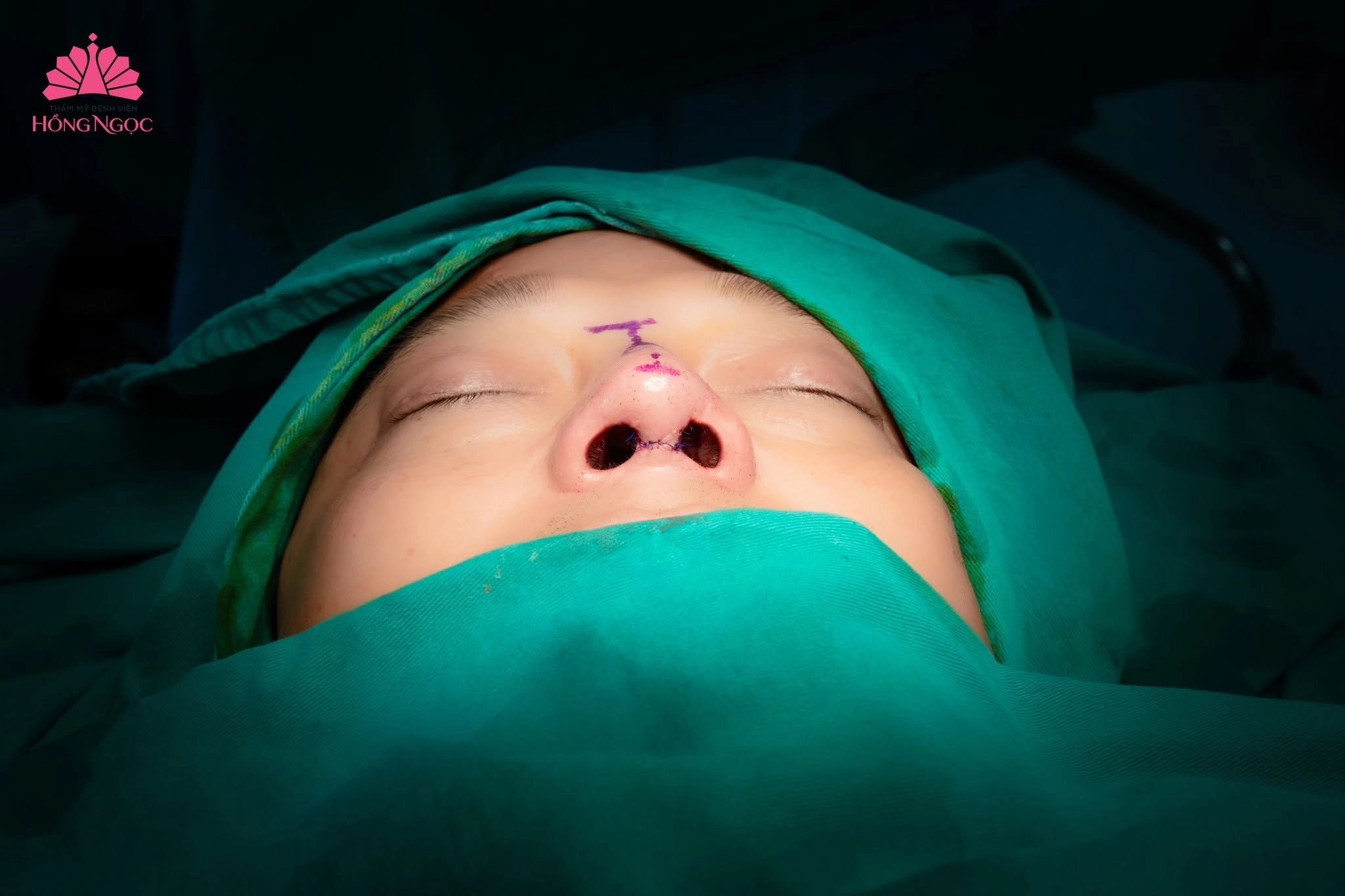 Nâng mũi độn cằm - Phương pháp cải thiện gương mặt toàn diện&nbsp;